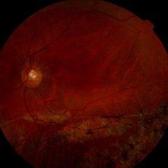 Fotografía del fondo de ojo