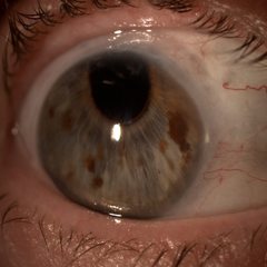 Ojo visto con lámpara de hendidura