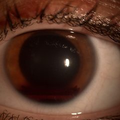 Ojo visto con lámpara de hendidura